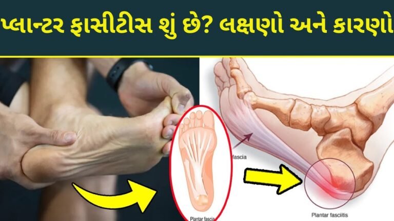 પ્લાન્ટર ફાસીટીસ શું છે, લક્ષણો અને કારણો.