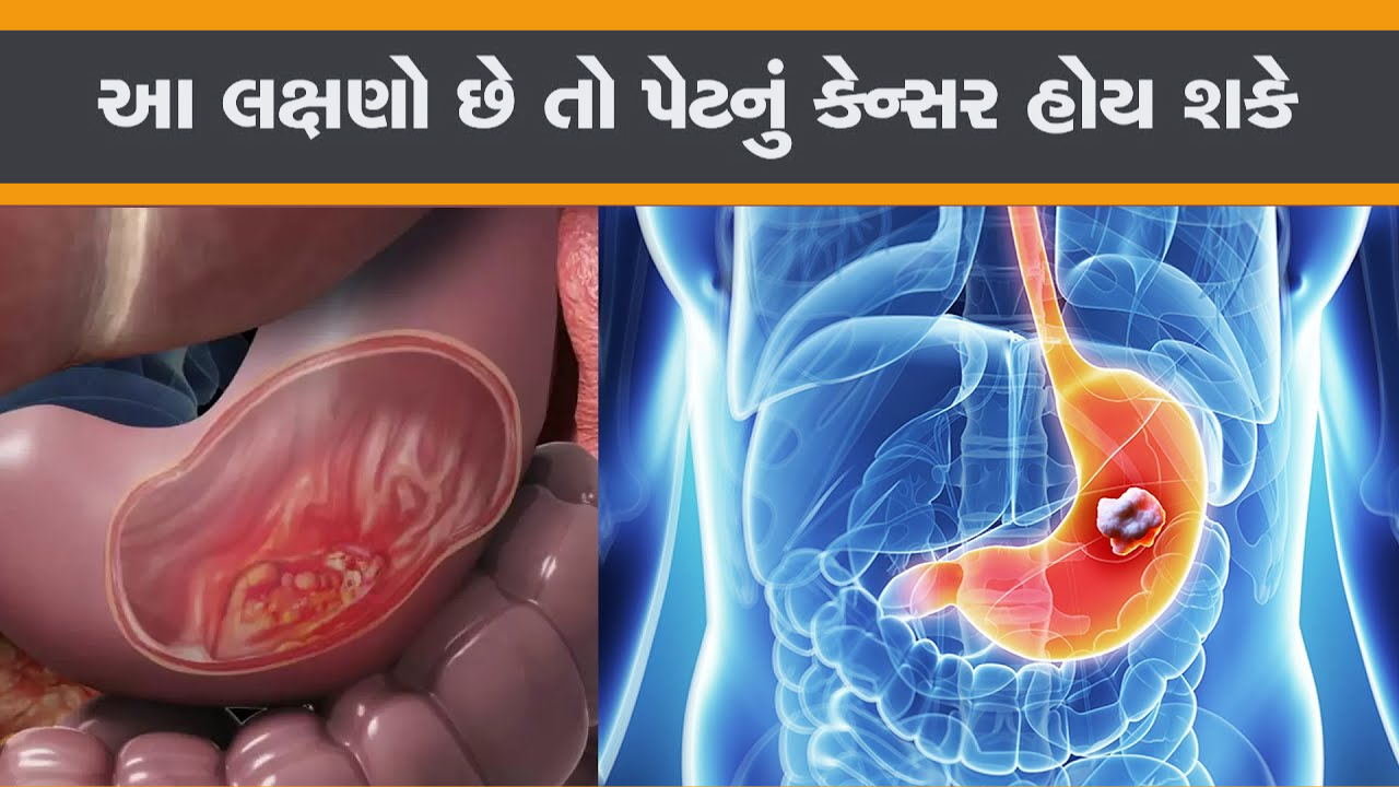 પેટના કેન્સરના લક્ષણો અને તેનાથી બચવાના ઉપાયો શું છે?